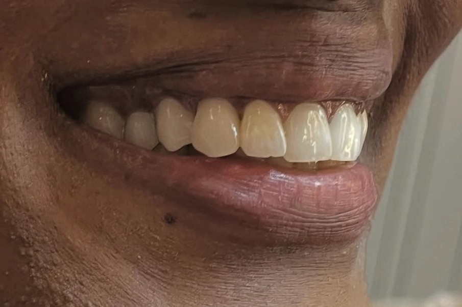 Implante dentário