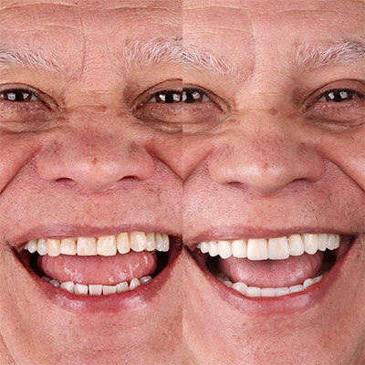 Implantes Dentários
